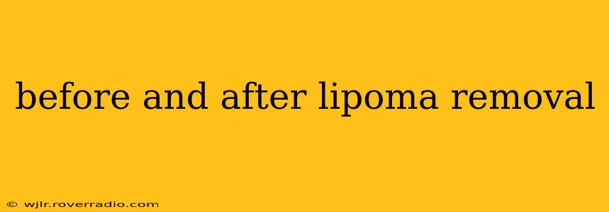 before and after lipoma removal