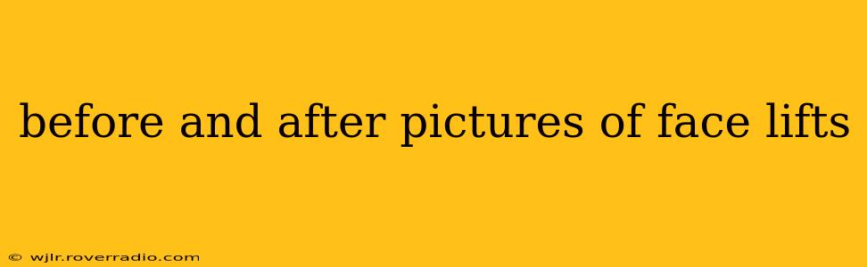 before and after pictures of face lifts