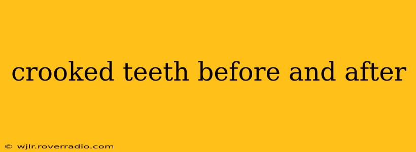 crooked teeth before and after