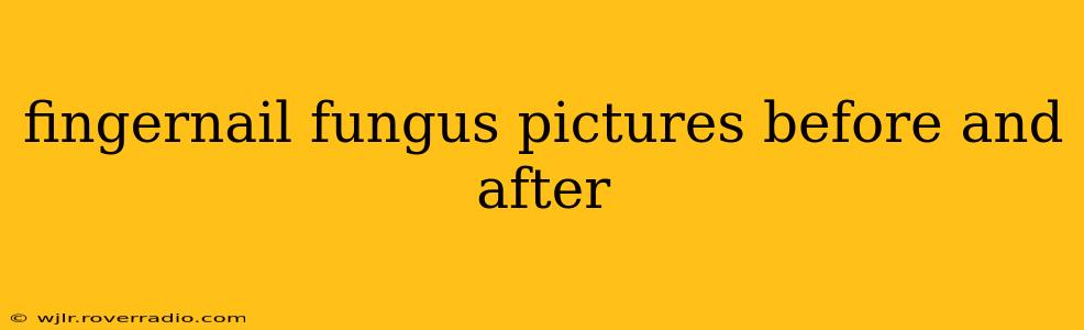 fingernail fungus pictures before and after