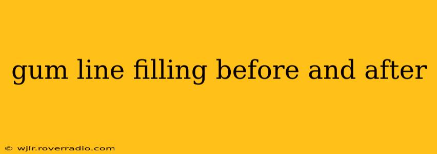 gum line filling before and after