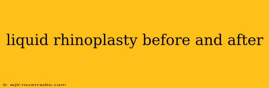 liquid rhinoplasty before and after