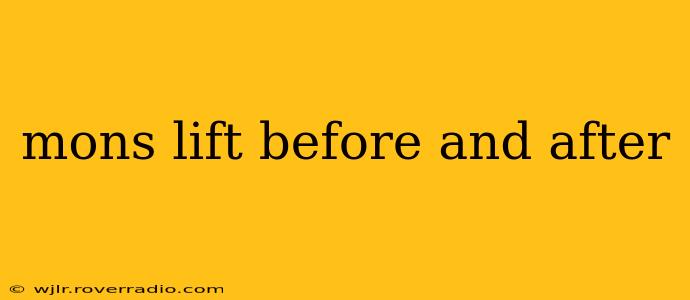 mons lift before and after