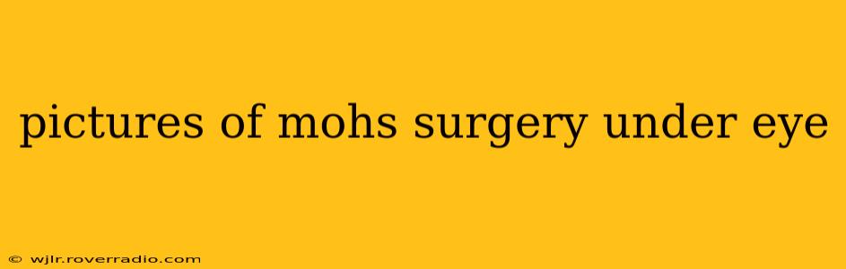 pictures of mohs surgery under eye