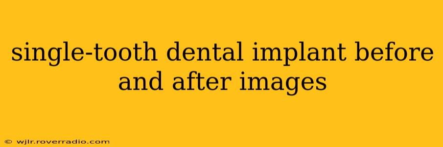 single-tooth dental implant before and after images