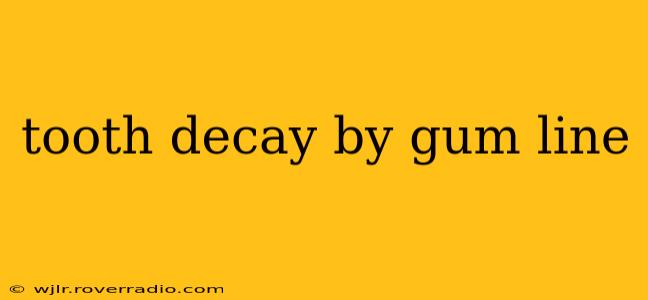 tooth decay by gum line